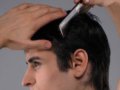 青年雄性秃头 5年内暴增2成