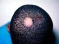 圆秃治疗面面观