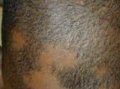 何谓圆形秃Alopecia Areata?