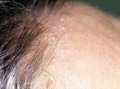 认识脂漏性皮肤炎 Seborrheic dermatitis