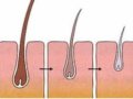 雄性秃的掉发过程