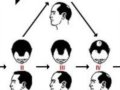 男性雄性秃的分类法 (NORWOOD CLASSIFICATION)