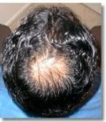 何谓雄性秃Male Pattern Baldness？