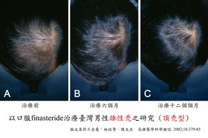 男性雄性禿
