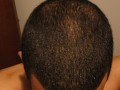 使用Finpecia生发口服药、头发维他命8个月恢复发量的雄性秃成功治疗个案