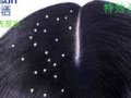 头皮屑及其成因
