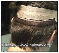 hair loss resistant donor area