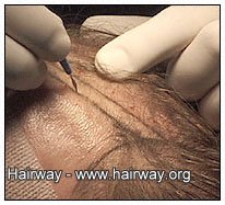hair transplant incisions