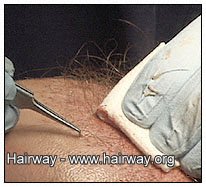 placing hair transplant grafts