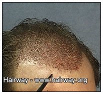 hair transplant close up