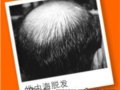干细胞为完全长回秃掉发提供了新希望