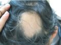 圆秃攻顶，压力？自体免疫疾病？