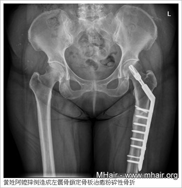 黃姓阿嬤摔倒造成左髖骨鎖定骨板治癒粉碎性骨折