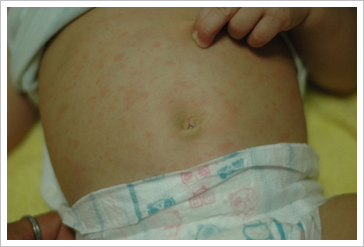 嬰兒罹患玫瑰疹 高燒起疹似花豹