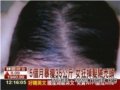 减重35公斤 女狂掉发险秃
